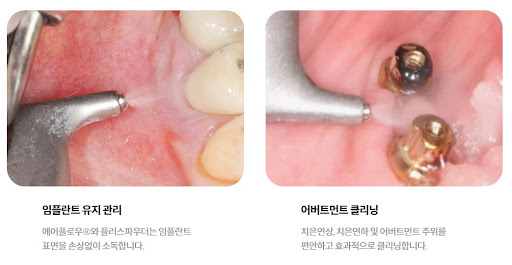 불당본점 서울비디치과의원, 천안 임플란트와 치아교정의 최신 장비와 기술로 높은 수준의 치료